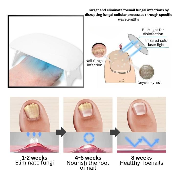 SEAGRIL PROMAX Revolutionary Light Therapy Device For Toenail Diseases