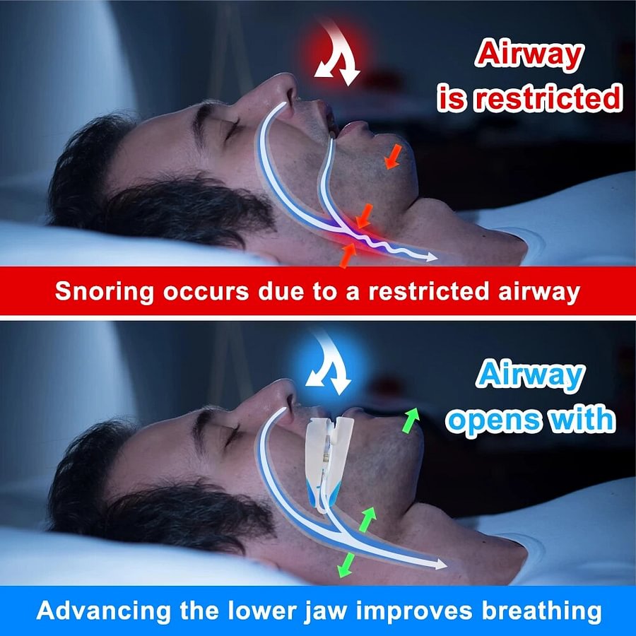 Anti-Snoring Mouthpiece