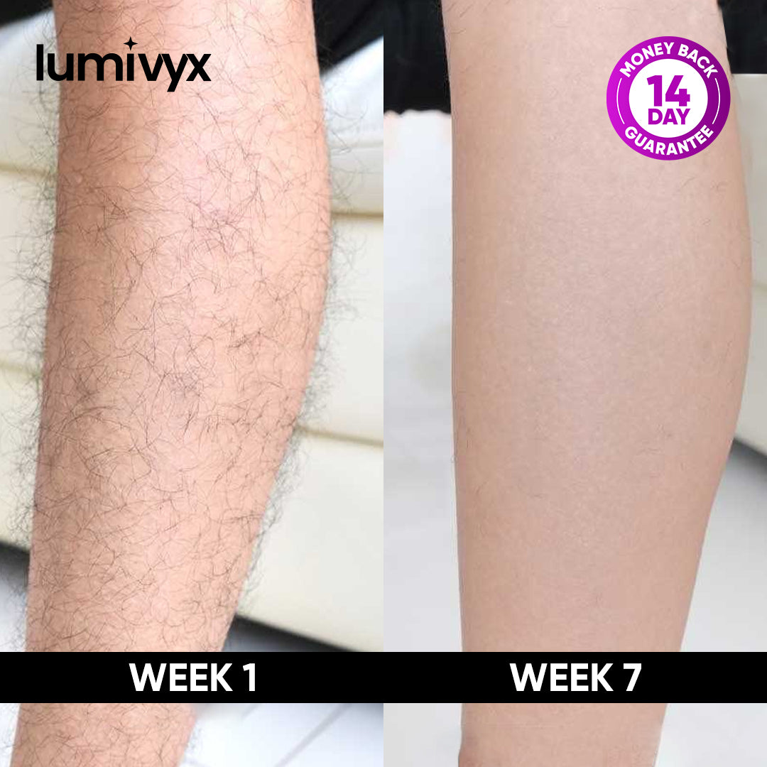 Lumivyx IPL Hair Removal