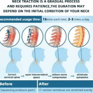 Cervictrex – Doctor Developed Neck Pain Relief Device through Cervical Spine Decompression.