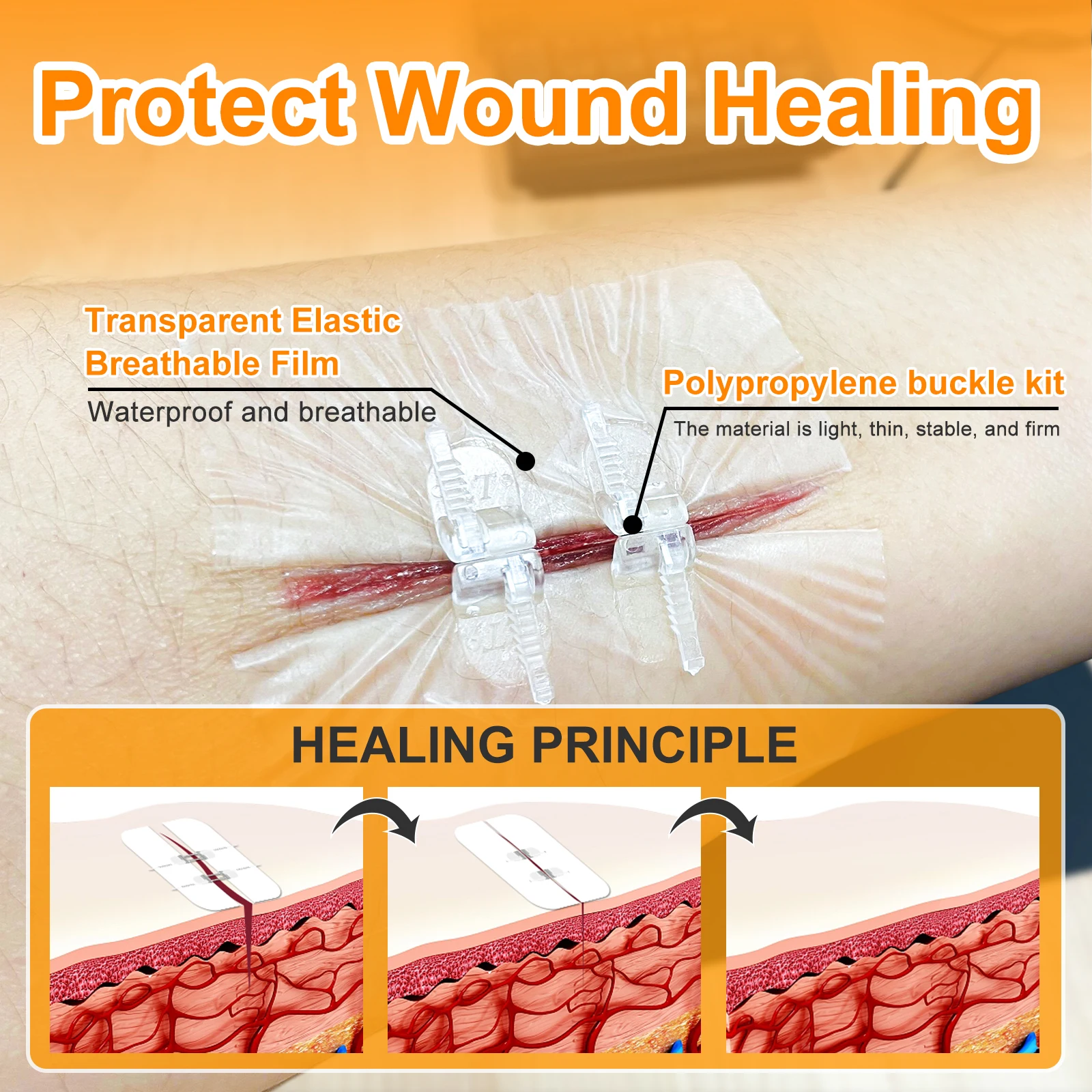 BindMD Wound Closure Device