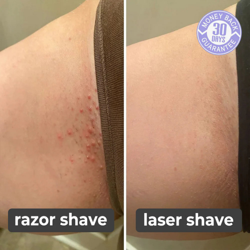 Laser Hair Remover Pro