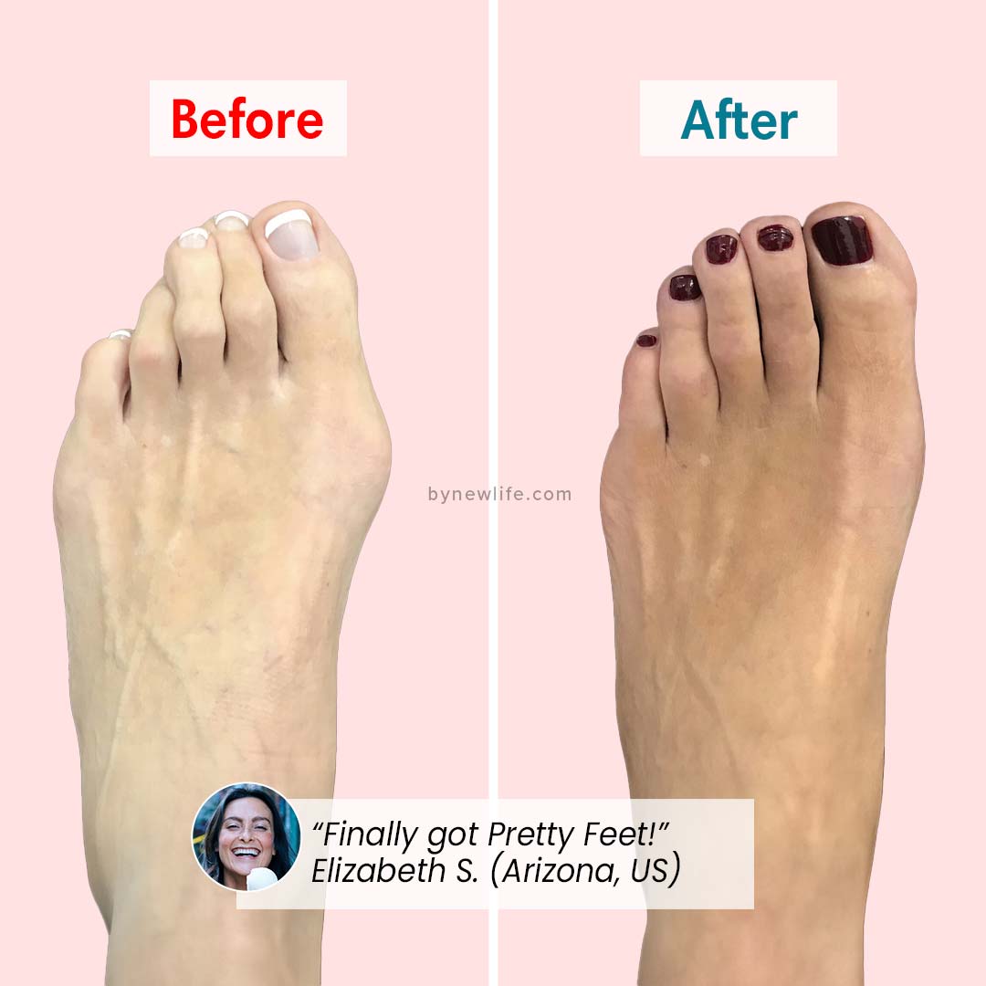 PerfectToes – Natural Toe Aligner