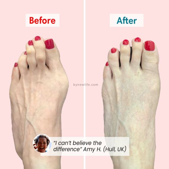 PerfectToes - Natural Toe Aligner