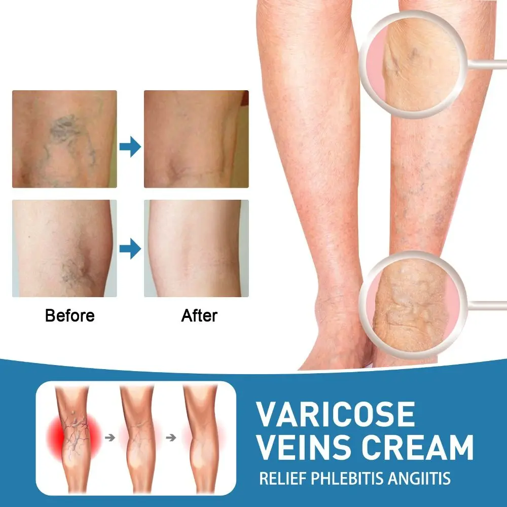 Raura Varicose Veins Treatment Cream