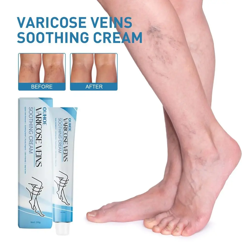 Raura Varicose Veins Treatment Cream