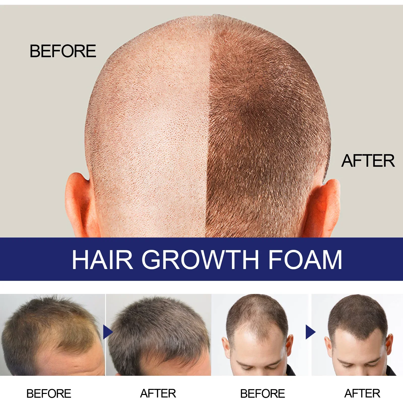 Renewhairx - Hair Growth Foam