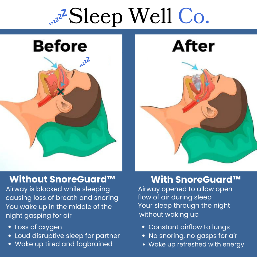 SnoreGuard for Sleep Apnea