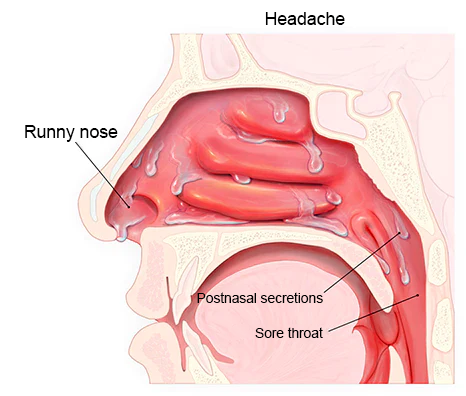 Nurbini RespiRelief red light nasal therapy device