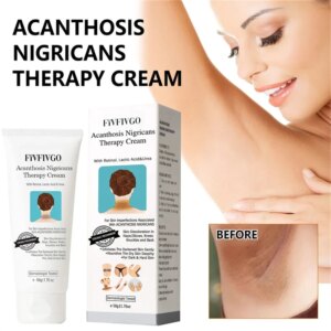 Seurico Acanthosis Nigricans Hyperpigmentation Therapy Cream