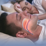 SleepEase Pro Anti-Snore Patch