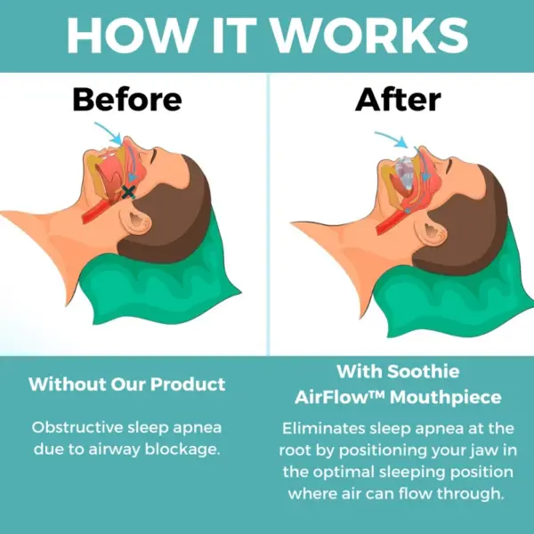 Bliss Guardian - Anti-snoring Mouthpiece