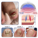 Furzero PureNail Fungus Laser Therapy Device