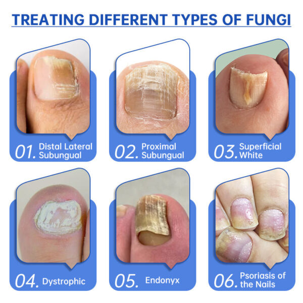 Furzero PureNail Fungus Laser Therapy Device