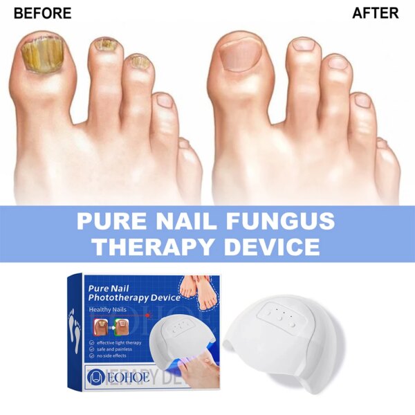 Furzero PureNail Fungus Laser Therapy Device