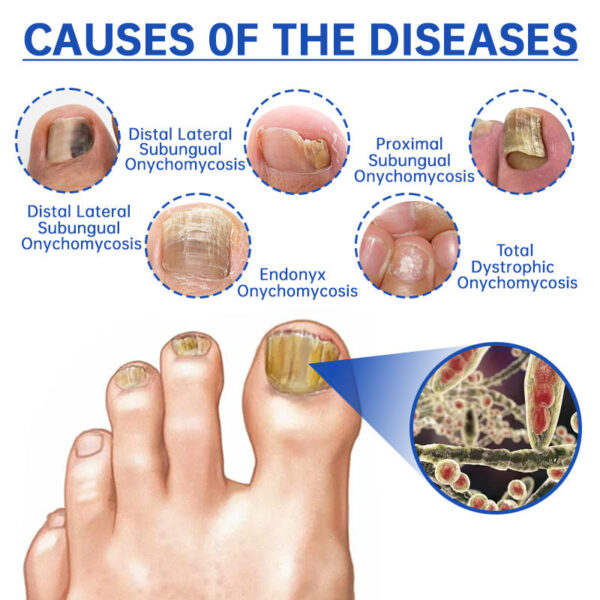 Furzero PureNail Fungus Laser Therapy Device