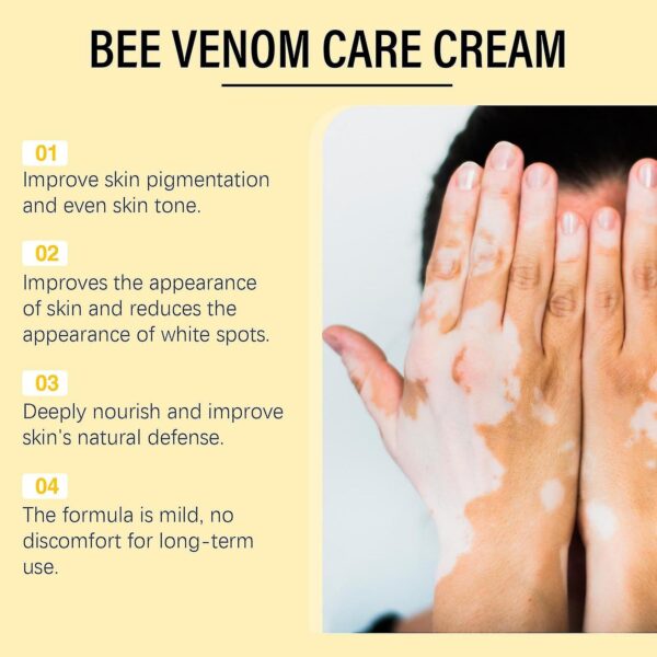 Bee Venom Vitiligo Cream