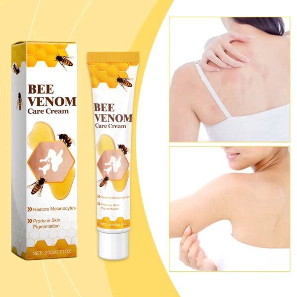 Bee Venom Vitiligo Cream