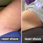 Cazoba - Laser Hair Remover