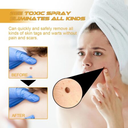 Medilisk Skin Tag Removal Spray
