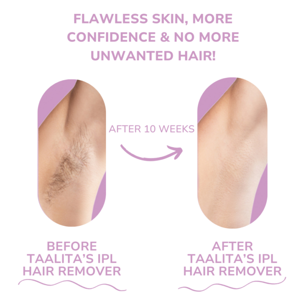 Taalitas IPL Hair Remover I The leading laser hair removal for your home