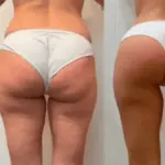 Cellu body sculpt - reduce cellulite and stretch marks