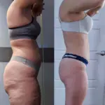 Cellu body sculpt - reduce cellulite and stretch marks