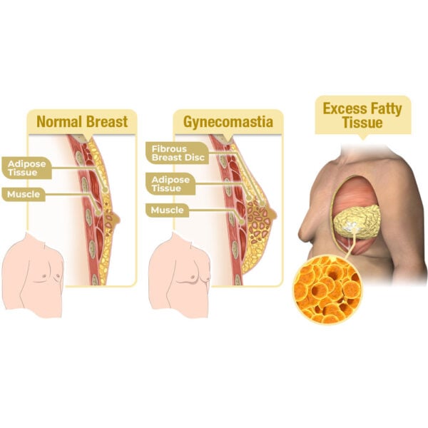 GFOUK MenTherm Bee Venom Gynecomastia Heating Oil