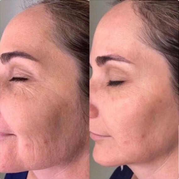 Wrinkle Pro - Face Sculptor 