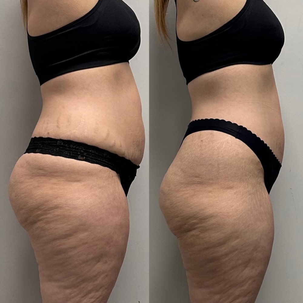 Cellulite Treatment before