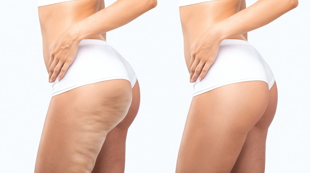 Cellulite Treatment comfort