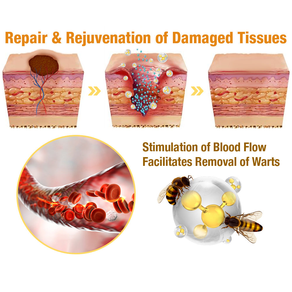 [AAD RECOMMENDS] Bee Venom Mole and Wart Treatment Cream Suitable for use byindividuals of all ages🍃