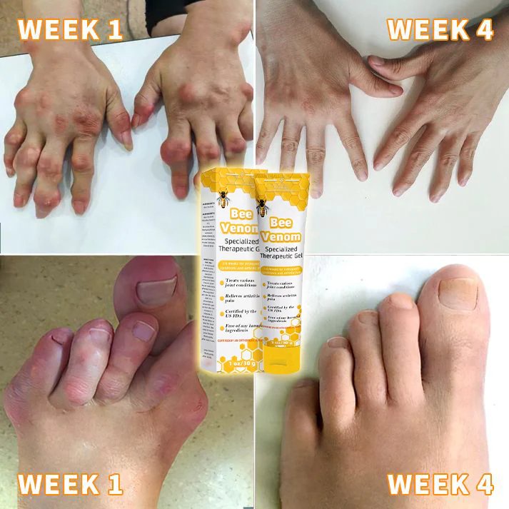 Bee Venom Joint Therapy Pain Relief Gel (New Zealand Bee Extract - Specializes in Orthopedic Diseases and Arthritis Pain)