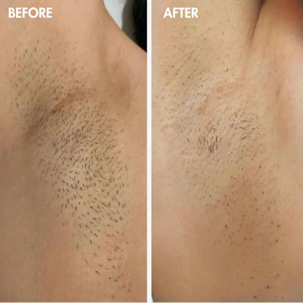 Soothe - Permanent Hair Removal Handset