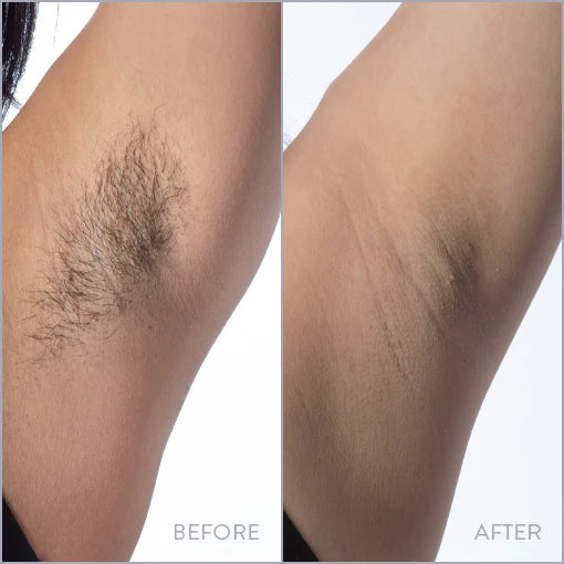 Soothe - Permanent Hair Removal Handset