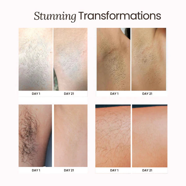 Soothe – Permanent Hair Removal Handset