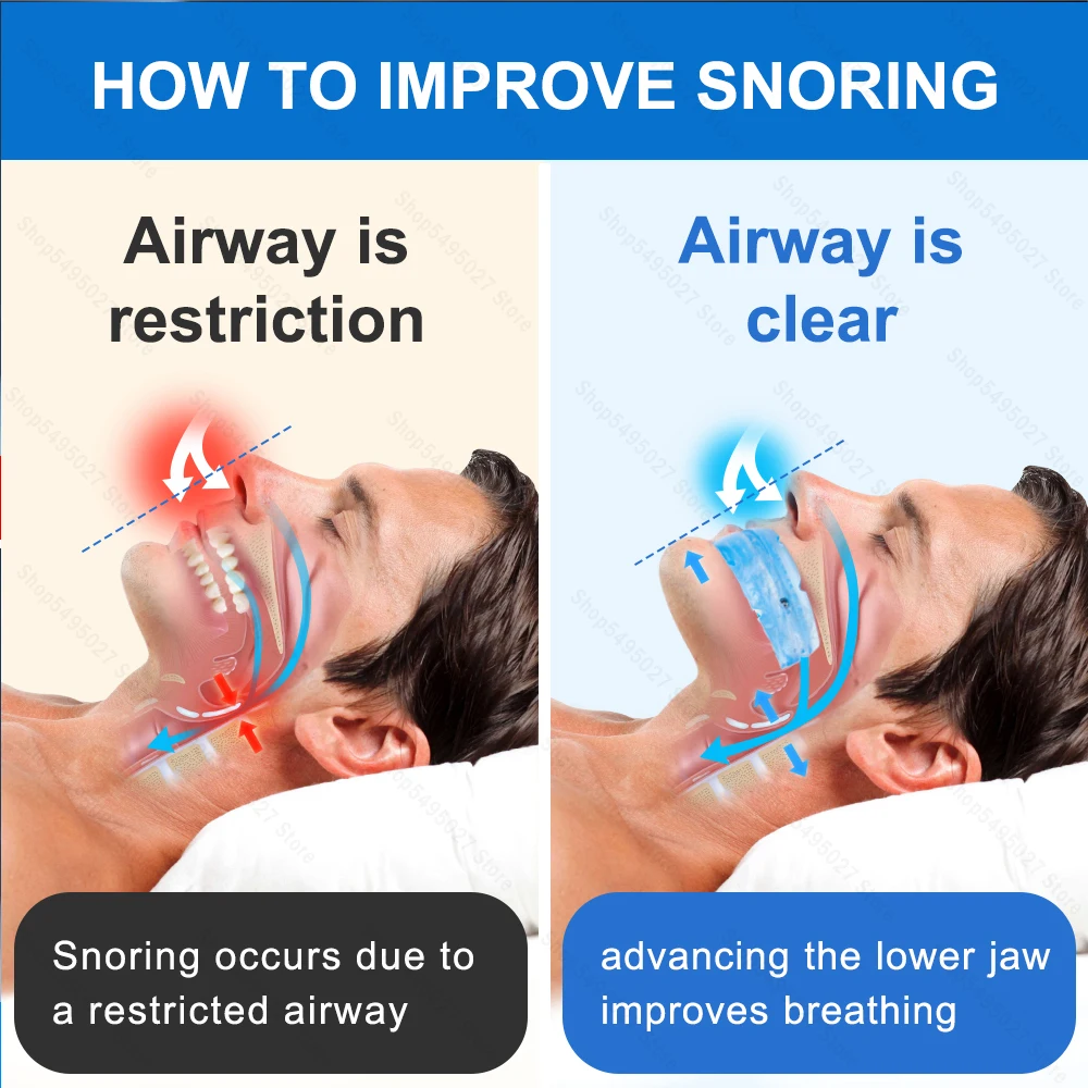 Anti-Snoring Mandibular Device