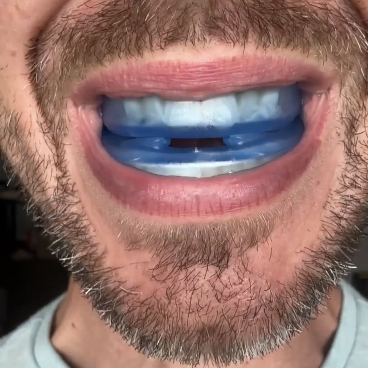 Anti-Snoring Mouthpiece