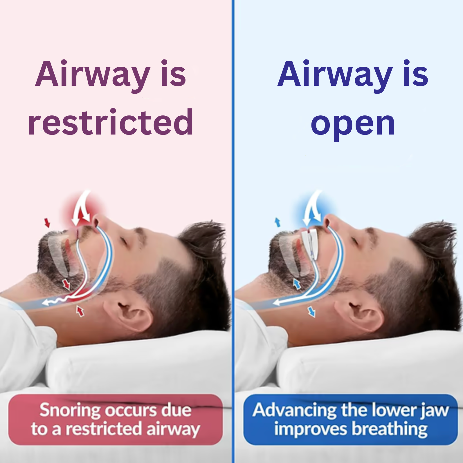 Anti Snoring Mouthpiece