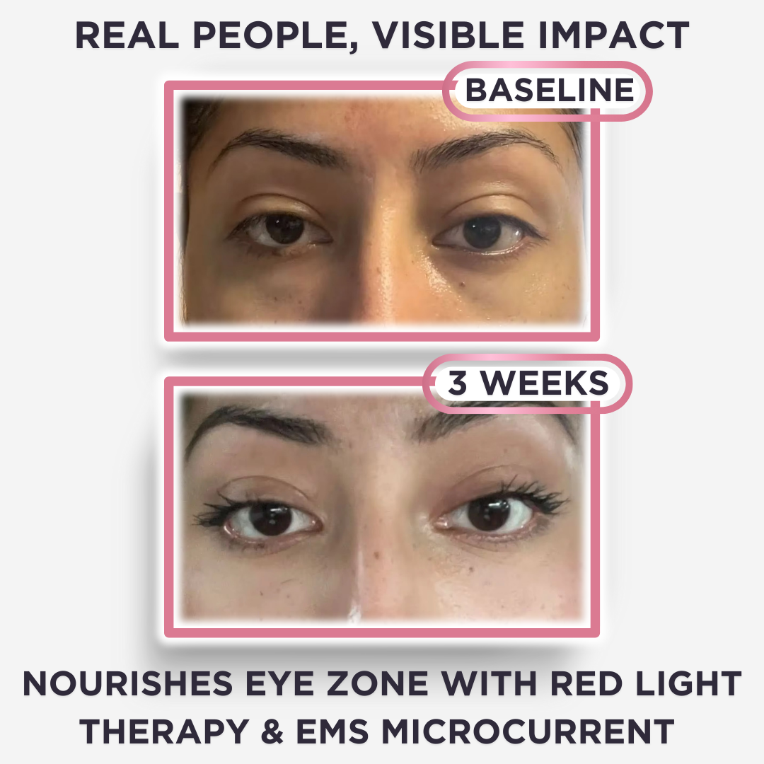 Under-Eye Red Light Therapy