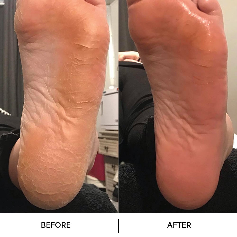 Callus Remover