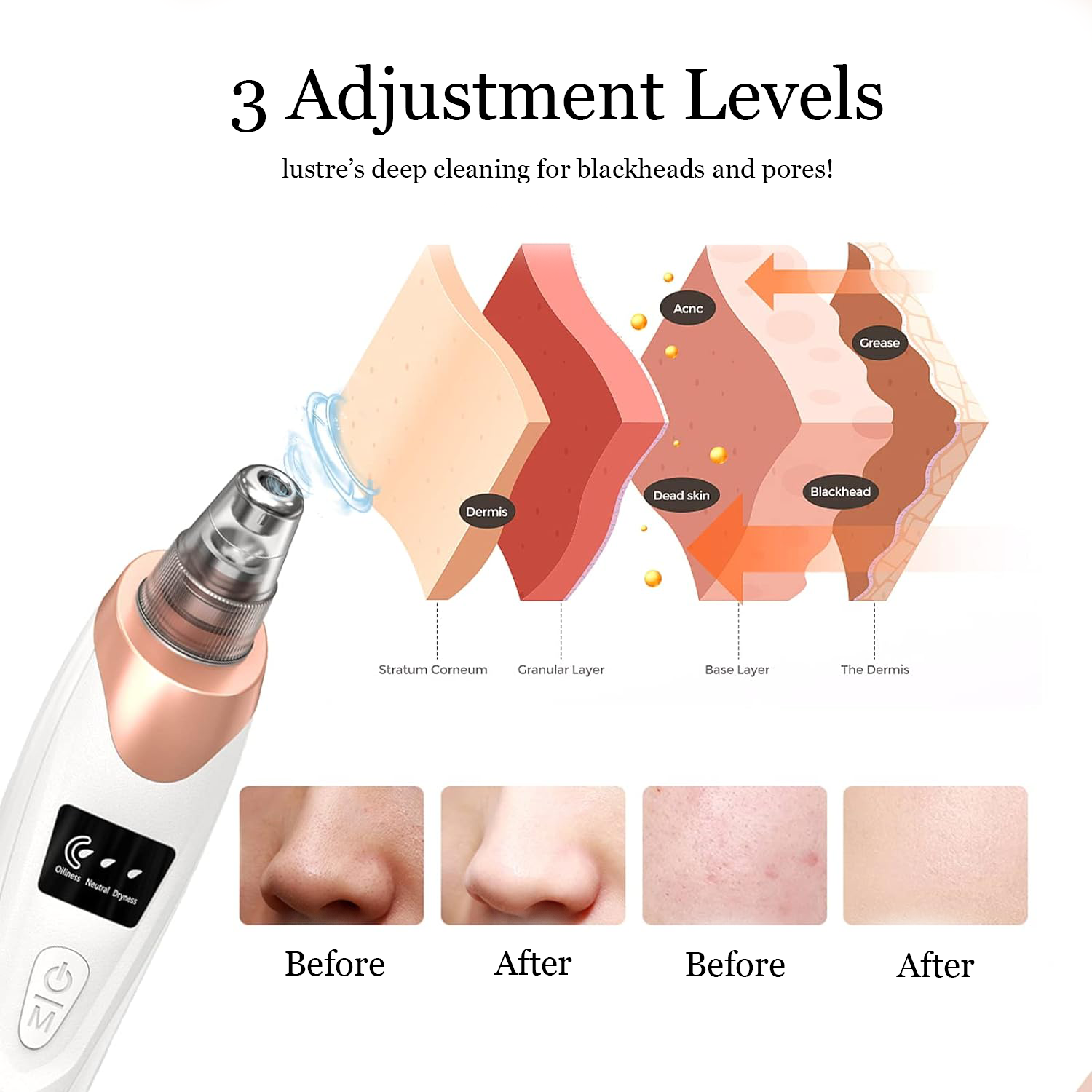 Lustre Blackhead & Pore Vacuum